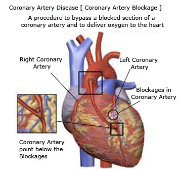 Coronary Artery Disease